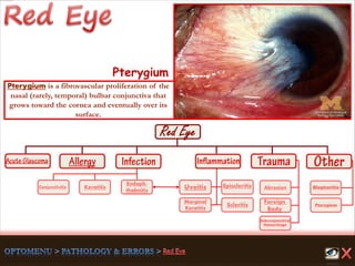 Endoph-
thalmitis
Keratitis
Scleritis
Marginal
Keratitis
Uveitis
Foreign
Body
Abrasion
Pterygium
Conjunctivitis
Subconjunctival
Hemorrhage
Episcleritis Blepharitis
Pterygium
Pterygium is a fibrovascular proliferation of the
nasal (rarely, temporal) bulbar conjunctiva that
grows toward the cornea and eventually over its
surface.
 