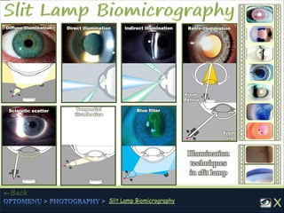 Diffuse illumination
Blue filter
Indirect illumination Retro-illumination
Sclerotic scatter
Direct illumination
From
Iris
From
Retina
Illumination
techniques
in slit lamp
←Back
Tangential
illumination
 