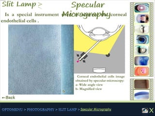 ←Back
Is a special instrument used to observe the corneal
endothelial cells .
Corneal endothelial cells image
obtained by specular microscopy:
a- Wide angle view
b- Magnified view
a b
 