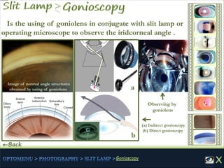 Is the using of goniolens in conjugate with slit lamp or
operating microscope to observe the iridcorneal angle .
←Back
Image of normal angle structures
obtained by using of goniolens
Observing by
goniolens
(a) Indirect gonioscopy
(b) Direct gonioscopy
a
b
 