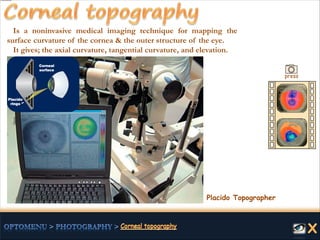 Placido Topographer
Is a noninvasive medical imaging technique for mapping the
surface curvature of the cornea & the outer structure of the eye.
It gives; the axial curvature, tangential curvature, and elevation.
press
Placido
rings
Corneal
surface
 