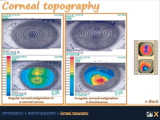 Regular corneal astigmatism in
a normal cornea
Irregular corneal astigmatism
in keratoconus ←Back
 