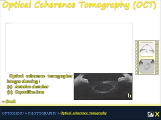 ←Back
a
b
Optical coherence tomographer
images showing :
(a) Anterior chamber
(b) Crystalline lens
 