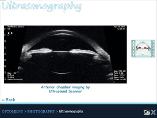 ←Back
Anterior chamber imaging by
Ultrasound Scanner
 