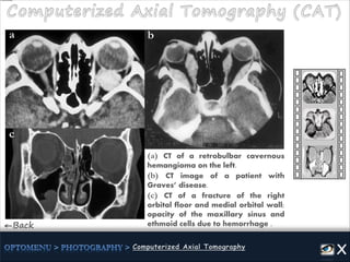 ←Back
(a) CT of a retrobulbar cavernous
hemangioma on the left.
(b) CT image of a patient with
Graves’ disease.
(c) CT of a fracture of the right
orbital floor and medial orbital wall;
opacity of the maxillary sinus and
ethmoid cells due to hemorrhage .
ba
c
 