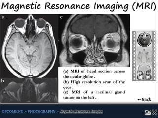 (a) MRI of head section across
the ocular globe .
(b) High resolution scan of the
eyes .
(c) MRI of a lacrimal gland
tumor on the left . ←Back
a
b
c
 