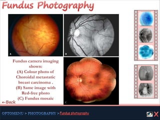 Fundus camera imaging
shown:
(A) Colour photo of
Choroidal metastatic
breast carcinoma .
(B) Same image with
Red-free photo
(C) Fundus mosaic
C←Back
 
