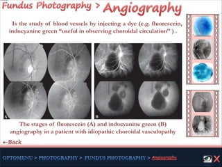 C←Back
The stages of fluorescein (A) and indocyanine green (B)
angiography in a patient with idiopathic choroidal vasculopathy
A B
Is the study of blood vessels by injecting a dye (e.g. fluorescein,
indocyanine green “useful in observing choroidal circulation” ) .
 