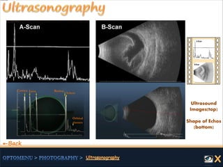 Ultrasound
Images(top)
Shape of Echos
(bottom)
←Back
Cornea Lens
Orbital
tissues
Sclera
Retina
 