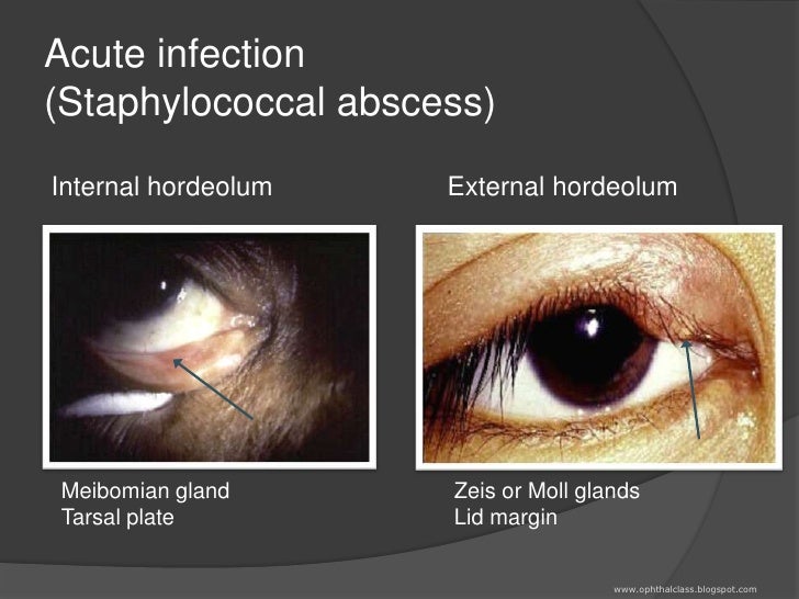 Lids and Adnexa Class1 The eyelid margin