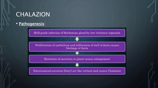 CHALAZION
• Pathogenesis:
 