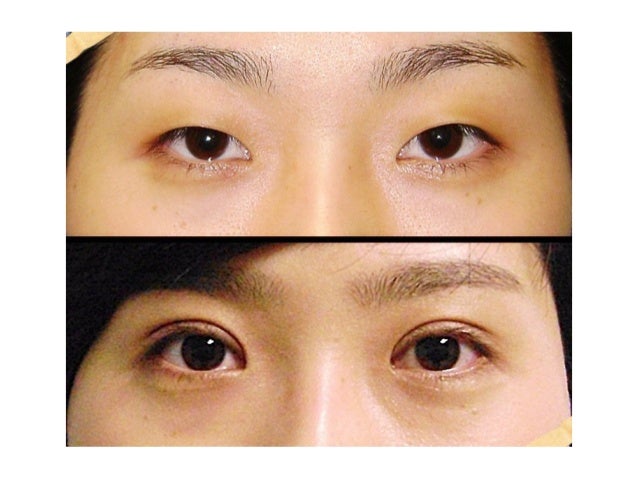 south korea double eyelid surgery