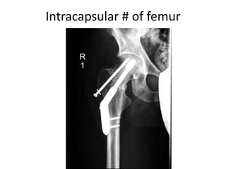 Intracapsular # of femur
 