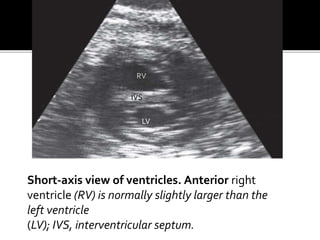 Short-axis view of ventricles. Anterior right
ventricle (RV) is normally slightly larger than the
left ventricle
(LV); IVS, interventricular septum.
RV
LV
IVS
 