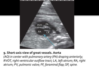 9. Short-axis view of great vessels. Aorta
(AO) in center with pulmonary artery (PA) draping anteriorly;
RVOT, right ventricular outflow tract; LA, left atrium; RA, right
atrium; PV, pulmonic valve; FF, foraminal flap; SP, spine.
AO
PARVO
T
RA LA
SP
FF
 
