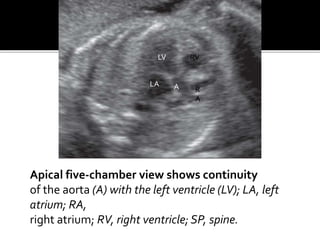 Apical five-chamber view shows continuity
of the aorta (A) with the left ventricle (LV); LA, left
atrium; RA,
right atrium; RV, right ventricle; SP, spine.
A
LV
LA
R
A
RV
 