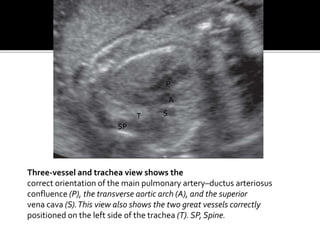 Three-vessel and trachea view shows the
correct orientation of the main pulmonary artery–ductus arteriosus
confluence (P), the transverse aortic arch (A), and the superior
vena cava (S).This view also shows the two great vessels correctly
positioned on the left side of the trachea (T). SP, Spine.
P
A
S
SP
T
 