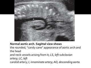 Normal aortic arch. Sagittal view shows
the rounded, “candy cane” appearance of aortic arch and
the head
and neck vessels arising from it; LS, left subclavian
artery; LC, left
carotid artery; I, innominate artery; AO, descending aorta.
A
O
LS
LC
I
 