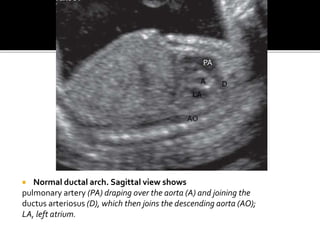  Normal ductal arch. Sagittal view shows
pulmonary artery (PA) draping over the aorta (A) and joining the
ductus arteriosus (D), which then joins the descending aorta (AO);
LA, left atrium.
PA
DA
LA
AO
 