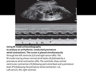 Using M-mode echocardiography
to analyze an arrhythmia: conducted premature
atrial contractions.The cursor is placed simultaneously
through the left ventricle (LV) and right atrium (RA).The
M-mode tracing shows normal atrial beats (A) followed by a
premature atrial contraction (PA).The ventricles show normal
ventricular contraction (V) following each atrial beat and a premature
beat (PV) following the premature atrial contraction. LA,
Left atrium; RV, right ventricle.
LV
R
A
A A A PA A
 