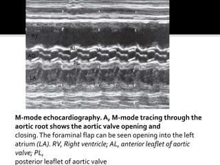 M-mode echocardiography. A, M-mode tracing through the
aortic root shows the aortic valve opening and
closing.The foraminal flap can be seen opening into the left
atrium (LA). RV, Right ventricle; AL, anterior leaflet of aortic
valve; PL,
posterior leaflet of aortic valve
AL
PL
AO
LA
RV
 