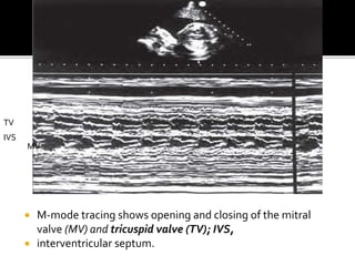  M-mode tracing shows opening and closing of the mitral
valve (MV) and tricuspid valve (TV); IVS,
 interventricular septum.
TV
IVS
MV
 