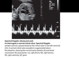 Spectral Doppler ultrasound used
to interrogate a normal mitral valve. Spectral Doppler
sample volume is placed distal to the mitral valve in the left ventricle
(LV). A normal mitral valve waveform is appreciated above
the baseline, showing the normal early diastolic (E) and atrial
contraction (A) wave points. LA, Left atrium; RA, right atrium;
RV, right ventricle; SP, spine
RV LV
RA LA
E
A
 