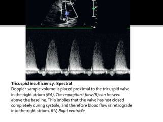 Tricuspid insufficiency. Spectral
Doppler sample volume is placed proximal to the tricuspid valve
in the right atrium (RA).The regurgitant flow (R) can be seen
above the baseline.This implies that the valve has not closed
completely during systole, and therefore blood flow is retrograde
into the right atrium. RV, Right ventricle
R
R
RA
RV
 