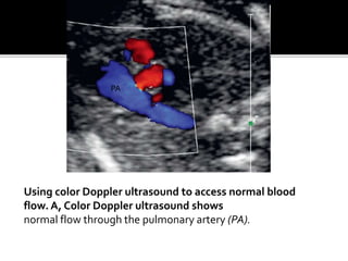 Using color Doppler ultrasound to access normal blood
flow. A, Color Doppler ultrasound shows
normal flow through the pulmonary artery (PA).
PA
 
