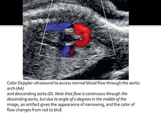 Color Doppler ultrasound to access normal blood flow through the aortic
arch (AA)
and descending aorta (D). Note that flow is continuous through the
descending aorta, but due to angle of 0 degrees in the middle of the
image, an artifact gives the appearance of narrowing, and the color of
flow changes from red to bluE
AA
D
 