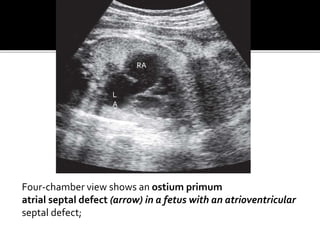 Four-chamber view shows an ostium primum
atrial septal defect (arrow) in a fetus with an atrioventricular
septal defect;
L
A
RA
 