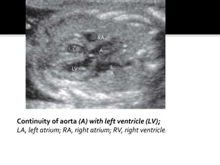 Continuity of aorta (A) with left ventricle (LV);
LA, left atrium; RA, right atrium; RV, right ventricle.
L
A
RA
A
LV
RV
 