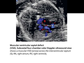 Muscular ventricular septal defect
(VSD). Subcostal four-chamber color Doppler ultrasound view
shows a muscularVSD (arrow) across the interventricular septum
(S); RA, right atrium; RV, right ventricle;
LA
RA
LV
RV
S
 