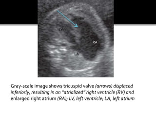 LV
RV
LA
RA
Gray-scale image shows tricuspid valve (arrows) displaced
inferiorly, resulting in an “atrialized” right ventricle (RV) and
enlarged right atrium (RA); LV, left ventricle; LA, left atrium
 
