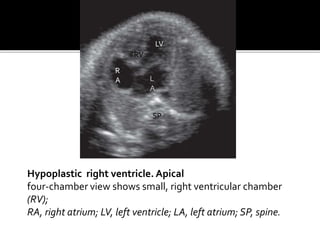 Hypoplastic right ventricle. Apical
four-chamber view shows small, right ventricular chamber
(RV);
RA, right atrium; LV, left ventricle; LA, left atrium; SP, spine.
LV
L
A
RV
R
A
SP
 