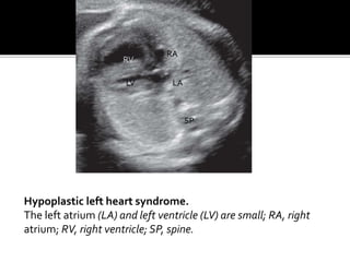 Hypoplastic left heart syndrome.
The left atrium (LA) and left ventricle (LV) are small; RA, right
atrium; RV, right ventricle; SP, spine.
RV
LV
SP
RA
LA
 
