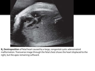 B, Dextroposition of fetal heart caused by a large, congenital cystic adenomatoid
malformation.Transverse image through the fetal chest shows the heart displaced to the
right, but the apex remaining Leftward.
S
P
R
A
RV
LV
L
A
 
