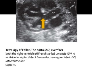 Tetralogy of Fallot.The aorta (AO) overrides
both the right ventricle (RV) and the left ventricle (LV). A
ventricular septal defect (arrows) is also appreciated. IVS,
Interventricular
septum.
RV
LV
IVS
AO
 