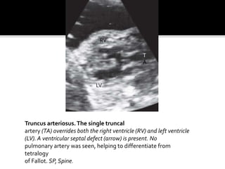 Truncus arteriosus.The single truncal
artery (TA) overrides both the right ventricle (RV) and left ventricle
(LV). A ventricular septal defect (arrow) is present. No
pulmonary artery was seen, helping to differentiate from
tetralogy
of Fallot. SP, Spine.
T
A
RV
LV
 