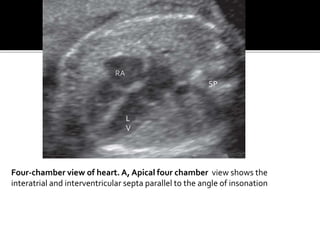 RA
L
V
SP
Four-chamber view of heart. A, Apical four chamber view shows the
interatrial and interventricular septa parallel to the angle of insonation
 
