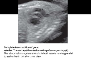 Complete transposition of great
arteries.The aorta (A) is anterior to the pulmonary artery (P).
This abnormal arrangement results in both vessels running parallel
to each other in this short-axis view.
A
P
 