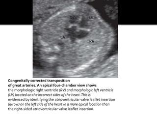 Congenitally corrected transposition
of great arteries. An apical four-chamber view shows
the morphologic right ventricle (RV) and morphologic left ventricle
(LV) located on the incorrect sides of the heart.This is
evidenced by identifying the atrioventricular valve leaflet insertion
(arrow) on the left side of the heart in a more apical location than
the right-sided atrioventricular valve leaflet insertion.
RV LV
LA
RA
 