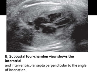 B, Subcostal four-chamber view shows the
interatrial
and interventricular septa perpendicular to the angle
of insonation.
 