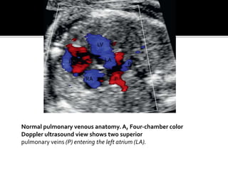 Normal pulmonary venous anatomy. A, Four-chamber color
Doppler ultrasound view shows two superior
pulmonary veins (P) entering the left atrium (LA).
RV
LV
RA
LA
P
P
 