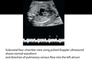 Subcostal four-chamber view using pulsed Doppler ultrasound
shows normal waveform
and direction of pulmonary venous flow into the left atrium
RA
LA
RV
LV
S D
 