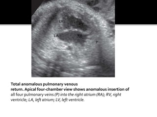 Total anomalous pulmonary venous
return. Apical four-chamber view shows anomalous insertion of
all four pulmonary veins (P) into the right atrium (RA); RV, right
ventricle; LA, left atrium; LV, left ventricle.
LV
LA RA
RV
P
 