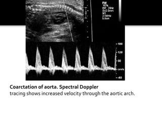 Coarctation of aorta. Spectral Doppler
tracing shows increased velocity through the aortic arch.
 