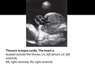 Thoracic ectopia cordis.The heart is
located outside the thorax; LA, left atrium; LV, left
ventricle;
RA, right ventricle; RV, right ventricle.
LV
 