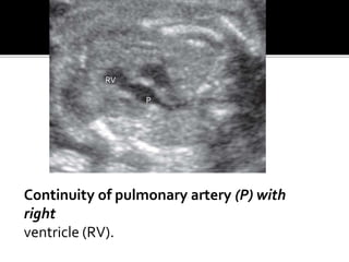 Continuity of pulmonary artery (P) with
right
ventricle (RV).
RV
P
 