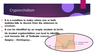 Cryptorchidism
It is a condition in males where one or both
testicles fails to decent From the abdomen to
scrotum.
It can be identified by an empty scrotum at birth.
Un treated cryptorchidism can lead to infertility
and increase risk of Testicular cancer.
Surgery – Orchiopexy .
 